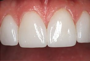 Midtown East Before and After Invisalign